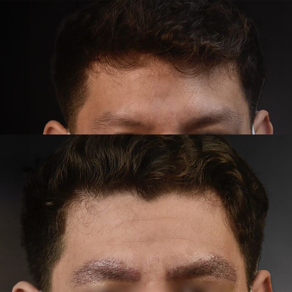 Before and after eyebrow transplant