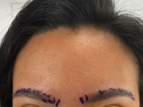 female eyebrow transplant patient before