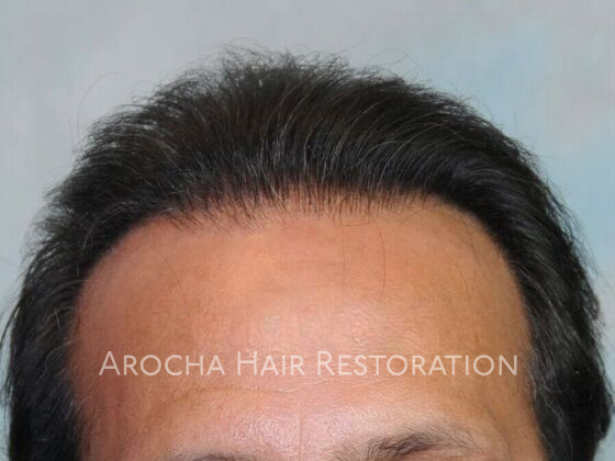 man after hair transplant revision surgery