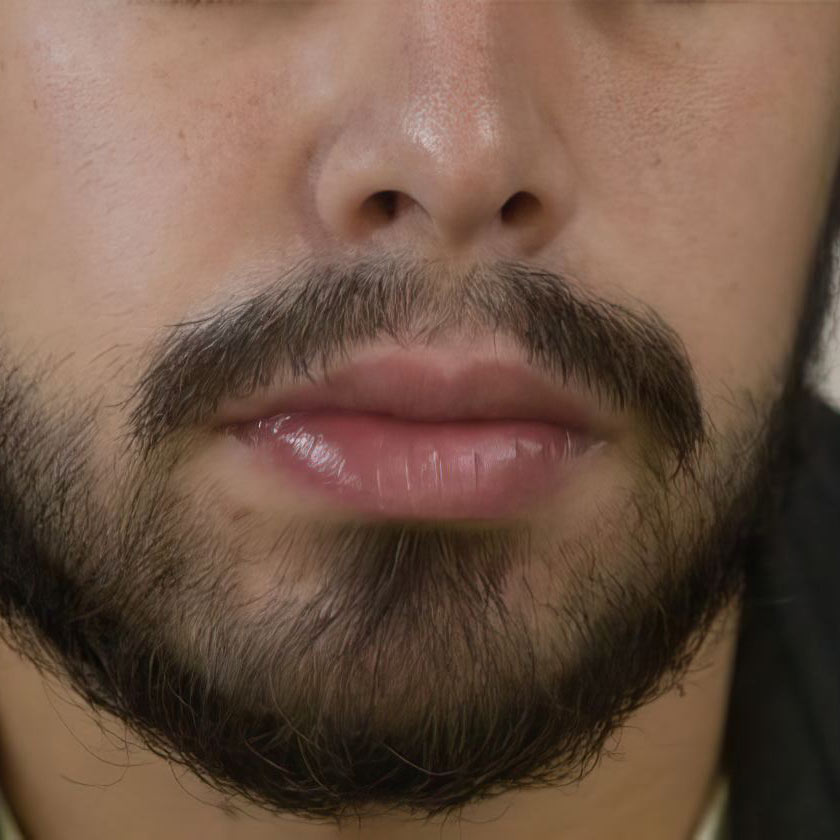 Case 2 After Facial Hair Transplant