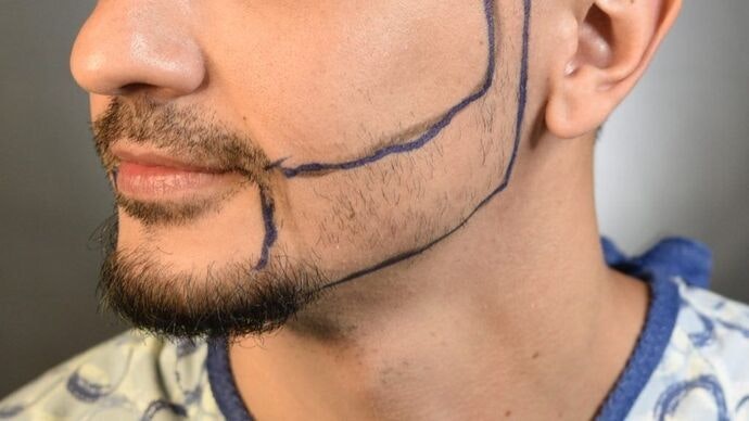 Before beard restoration