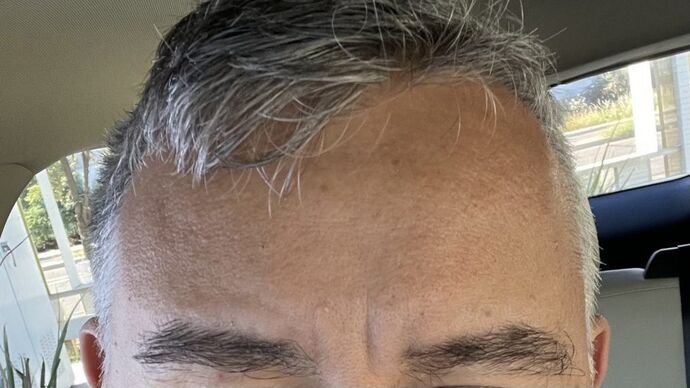 After eyebrow and beard hair transplant