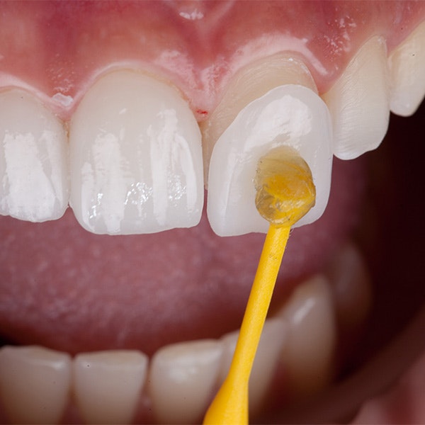 dental veneer