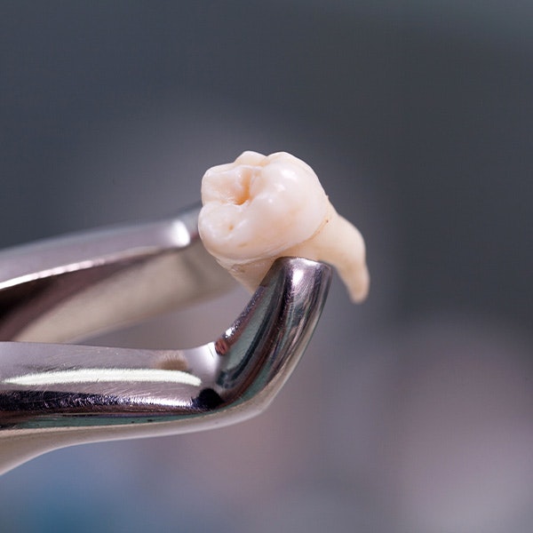 a wisdom tooth