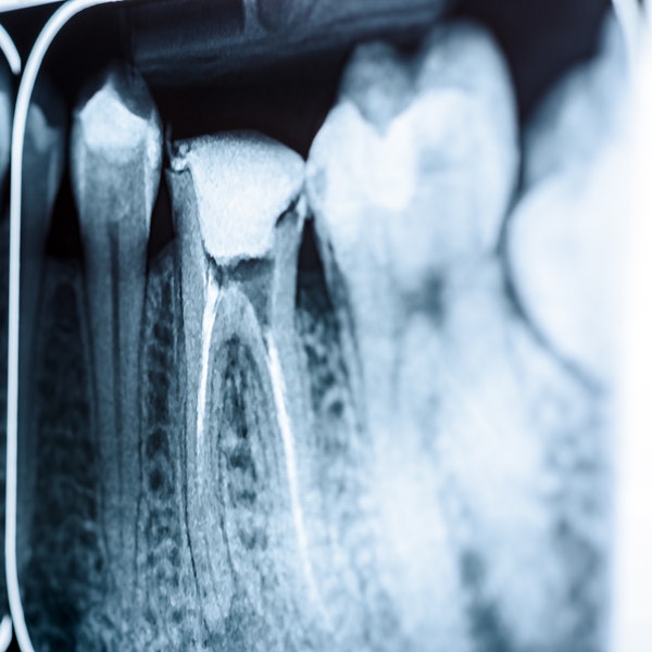 teeth xrays