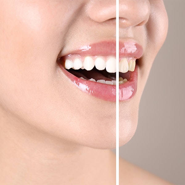 close up of a smile before and after teeth whitening