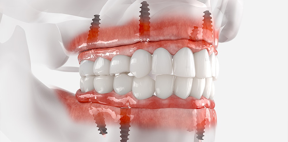 3D illustration of All on 4 dentures
