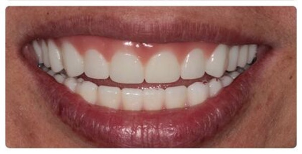 Marietta patient after restorative dentistry