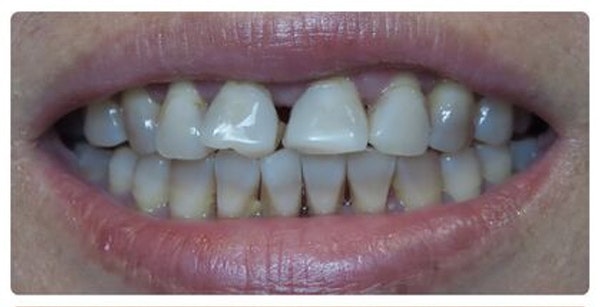Marietta patient before restorative dentistry