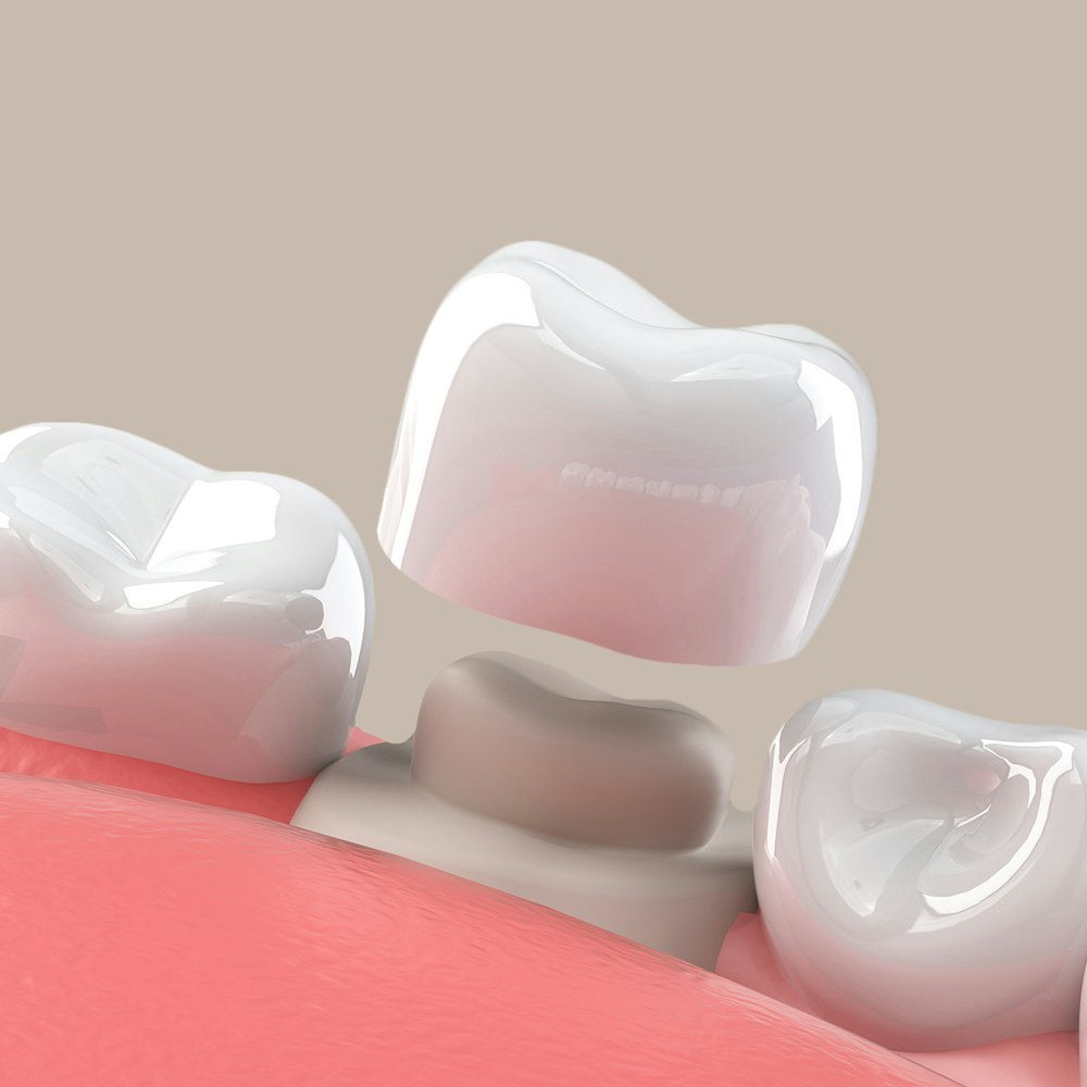 a 3d render of a dental crown being applied to a tooth