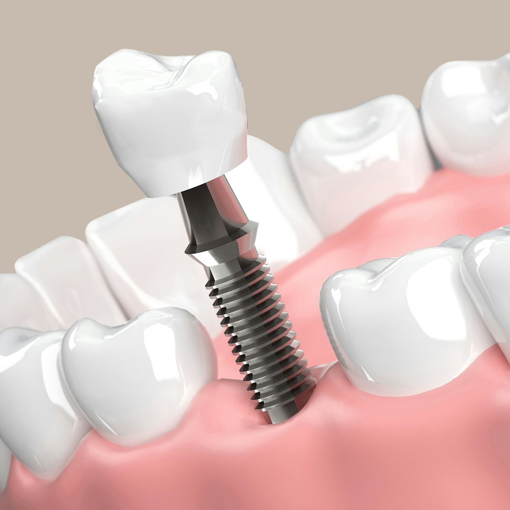 a 3d render of a dental implant being implanted into gums