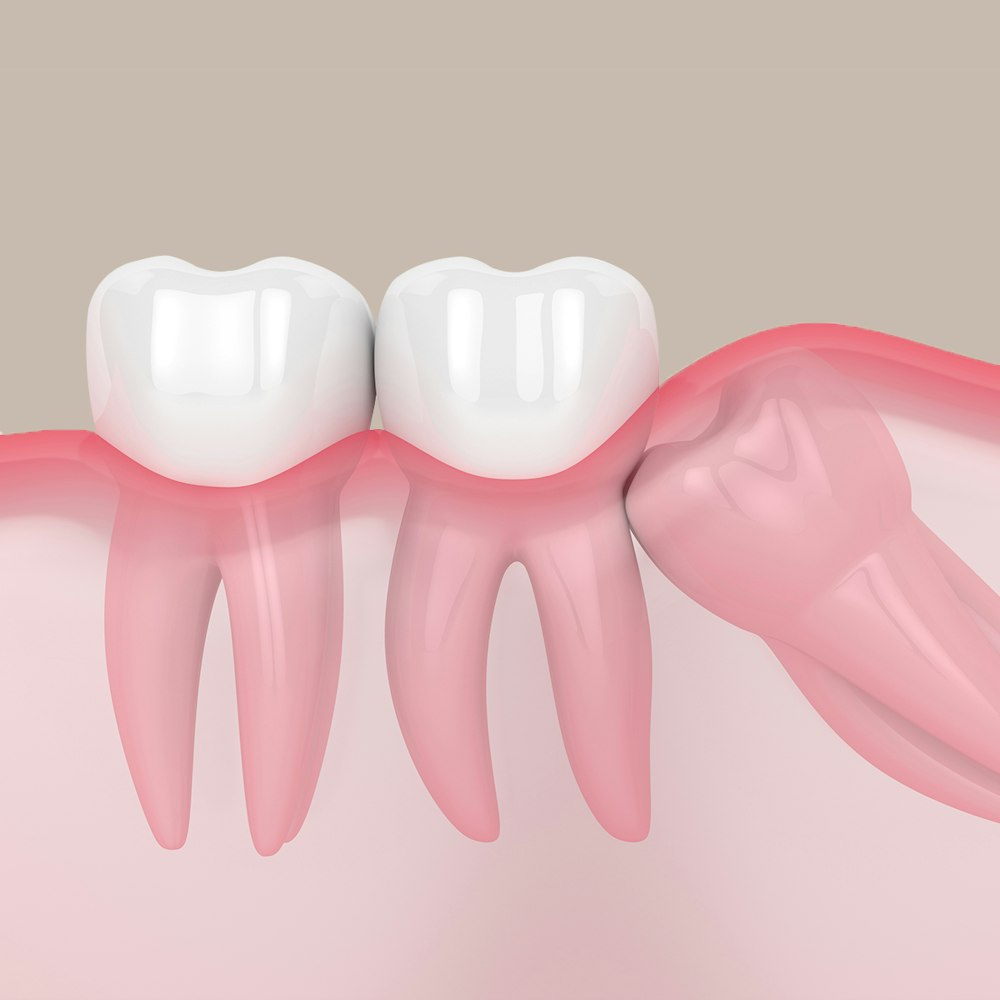 a 3d render of impacted wisdom tooth