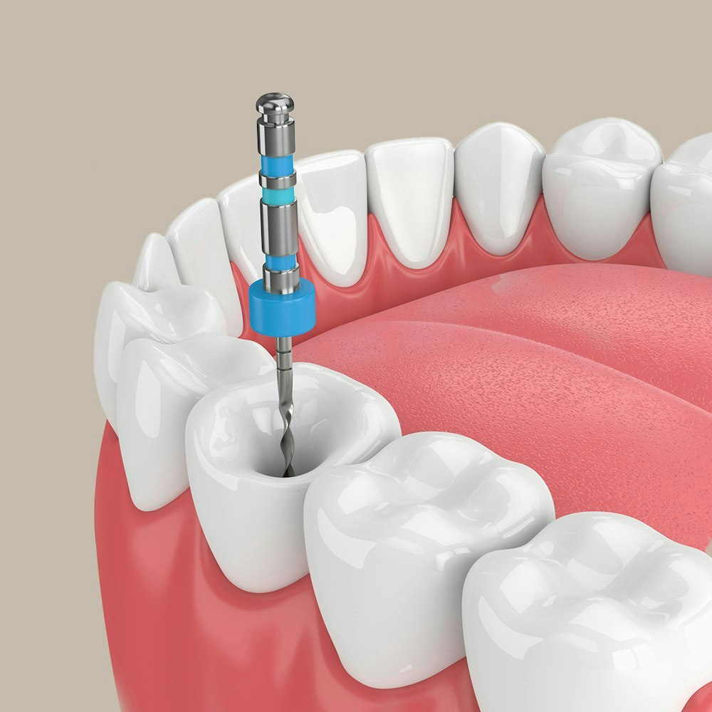 a 3d render of a root canal procedure