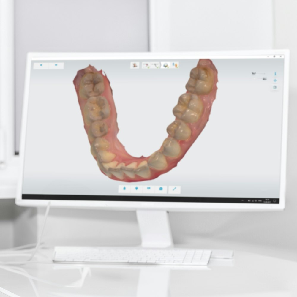 A full arch of teeth 3d model on a monitor