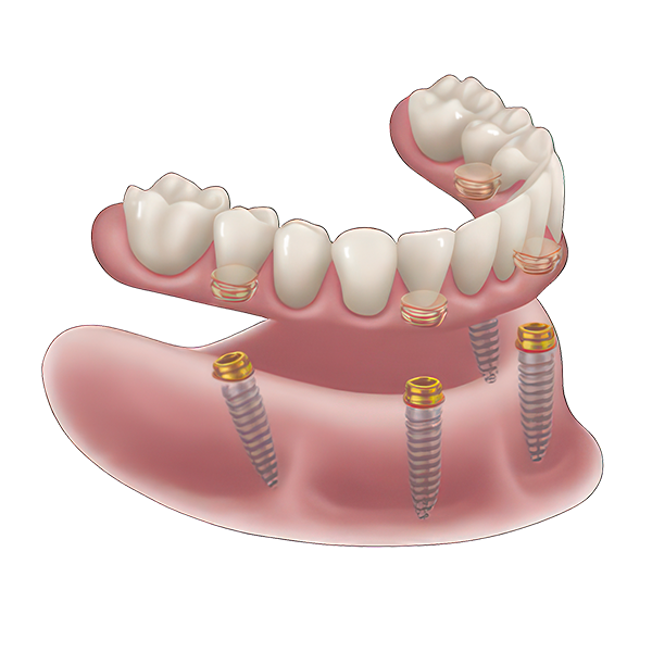 Fixed Appliance Illustration