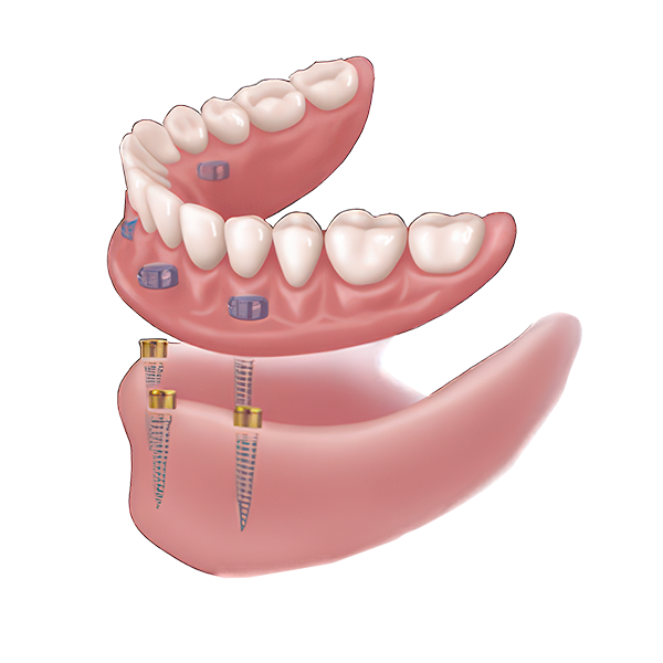 Overdenture Illustration