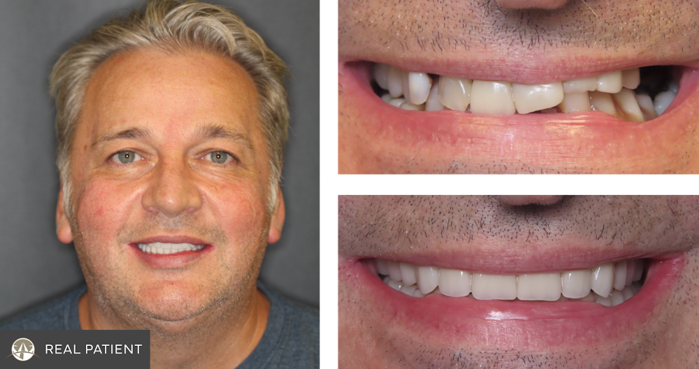 invisalign patient before and after