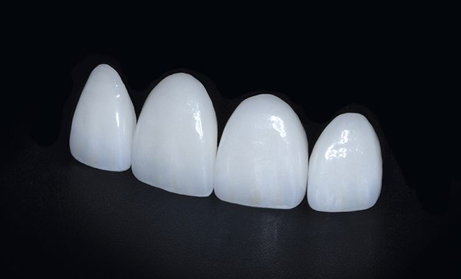 emax Veneers