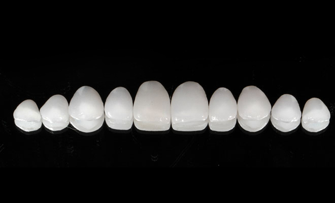Durathin veneers