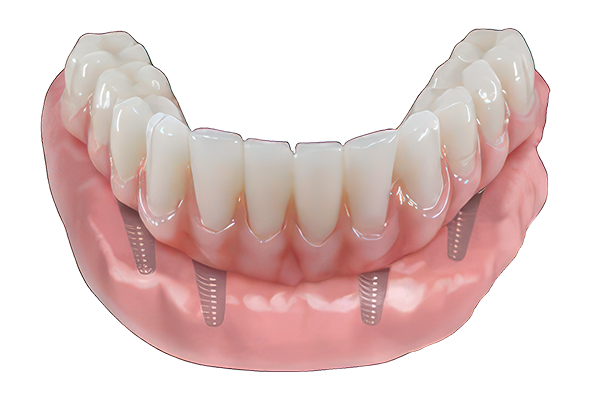 All-on-4 illustration