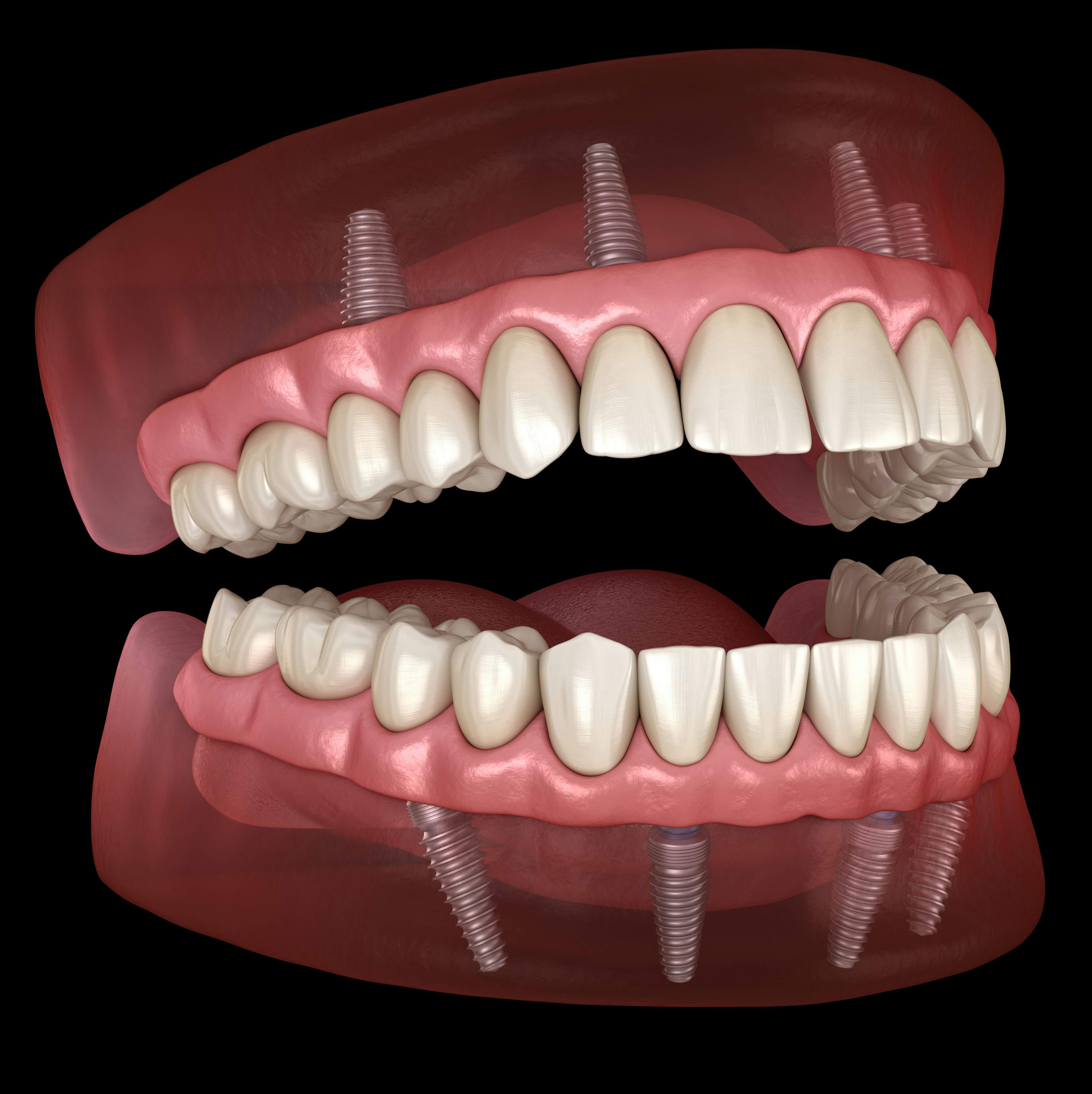 Model of All-on-4 technique