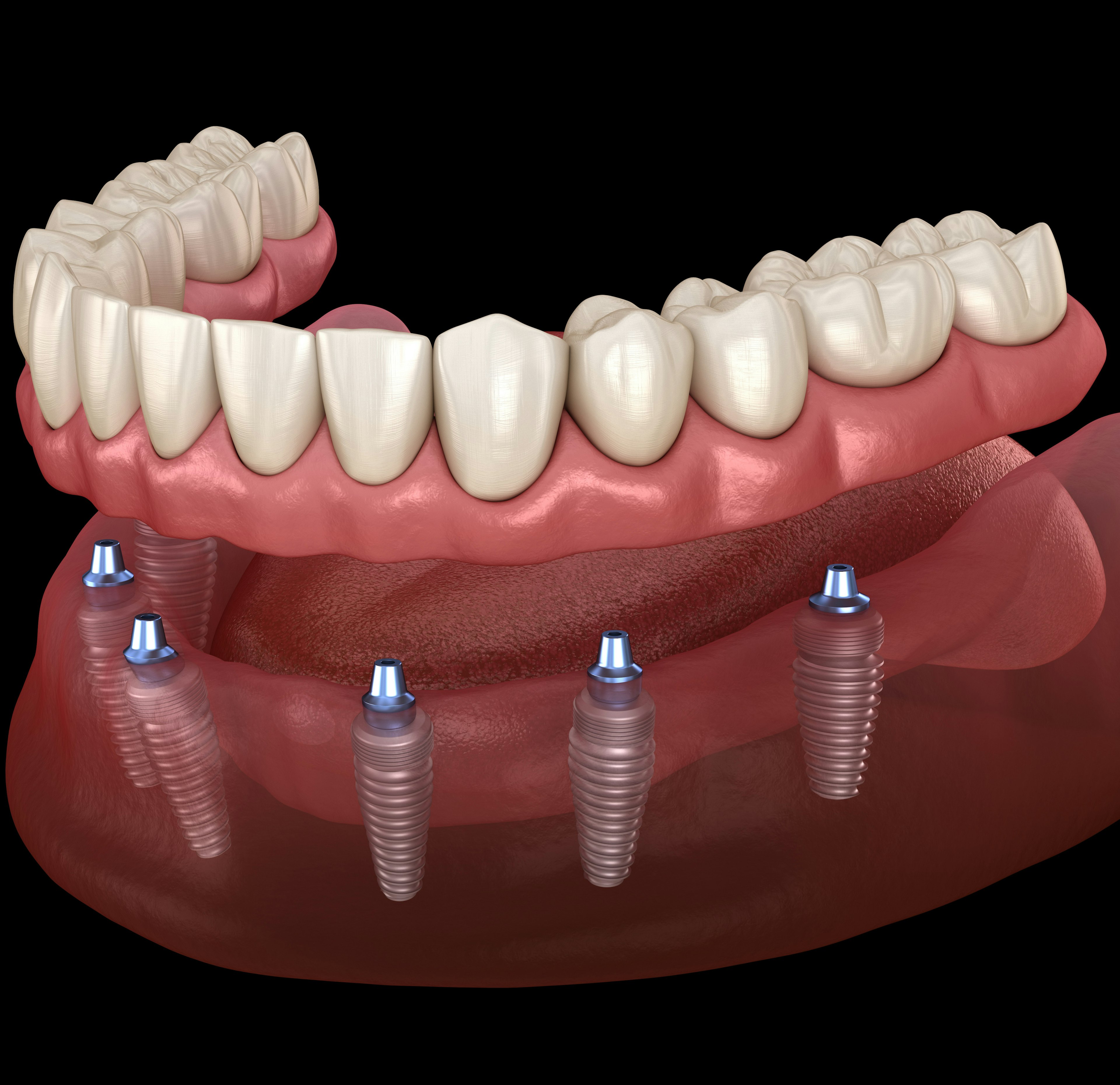 All-on-6 restoration