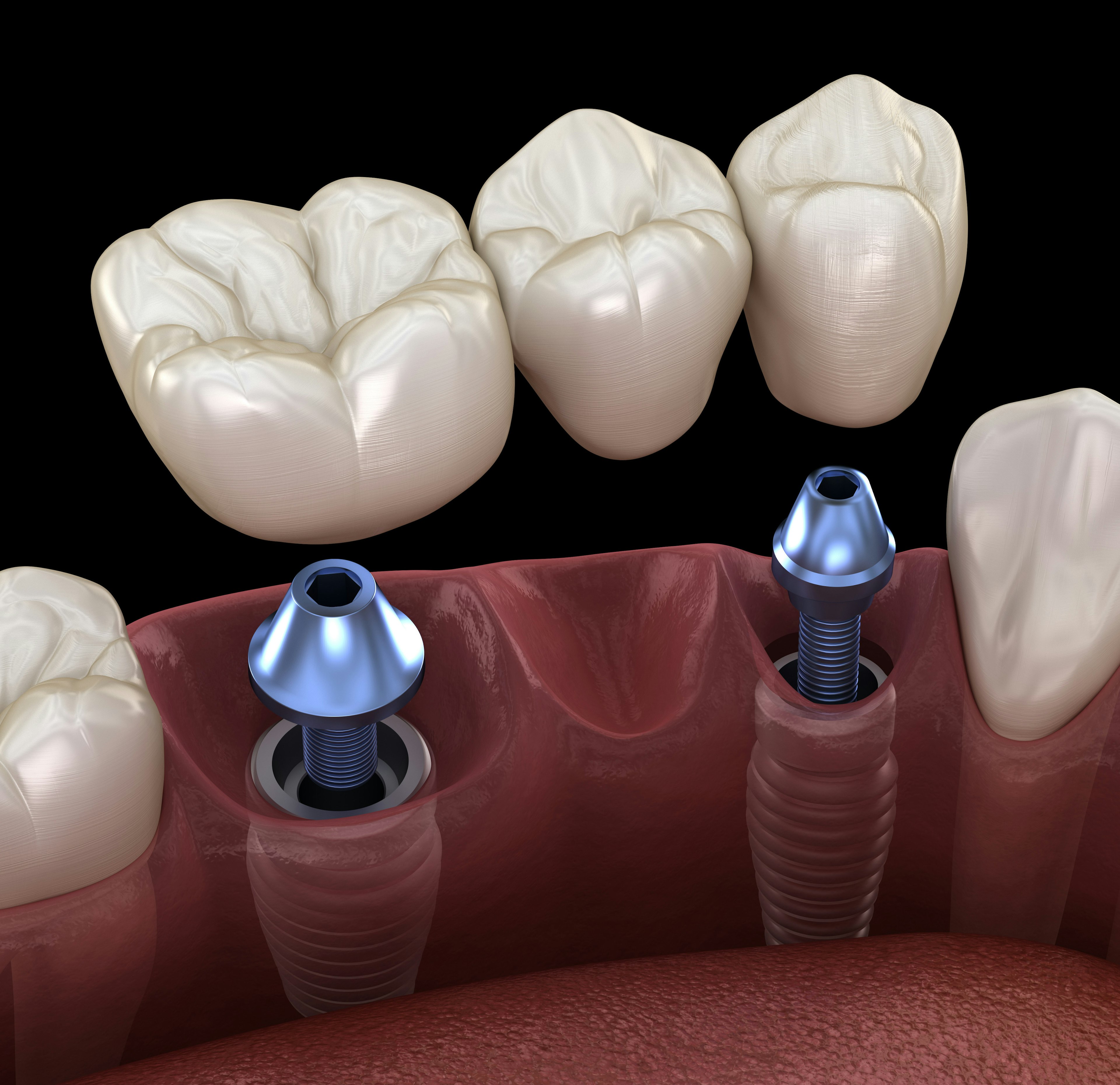 Implant-supported bridge