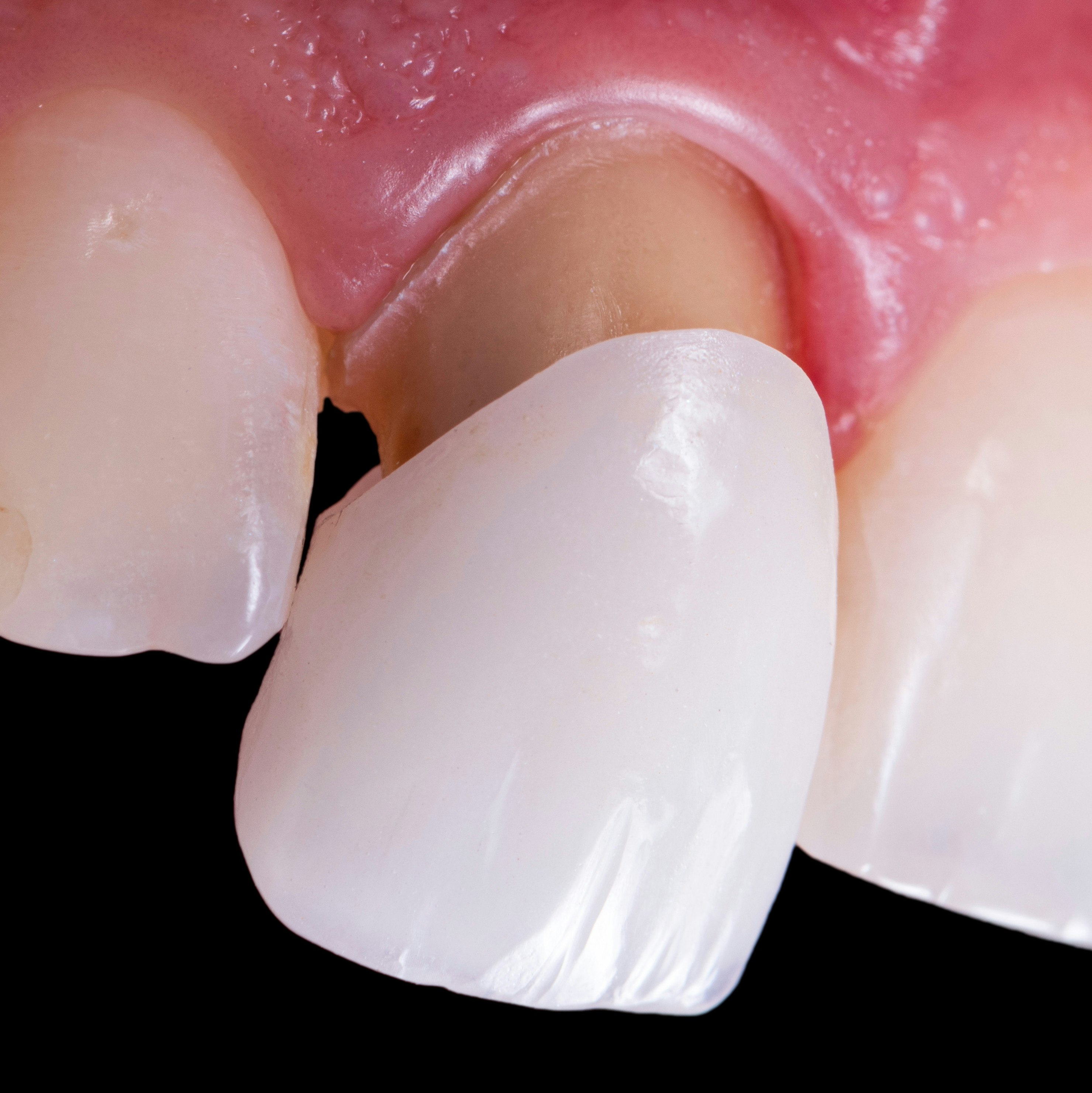 Veneer over a front tooth