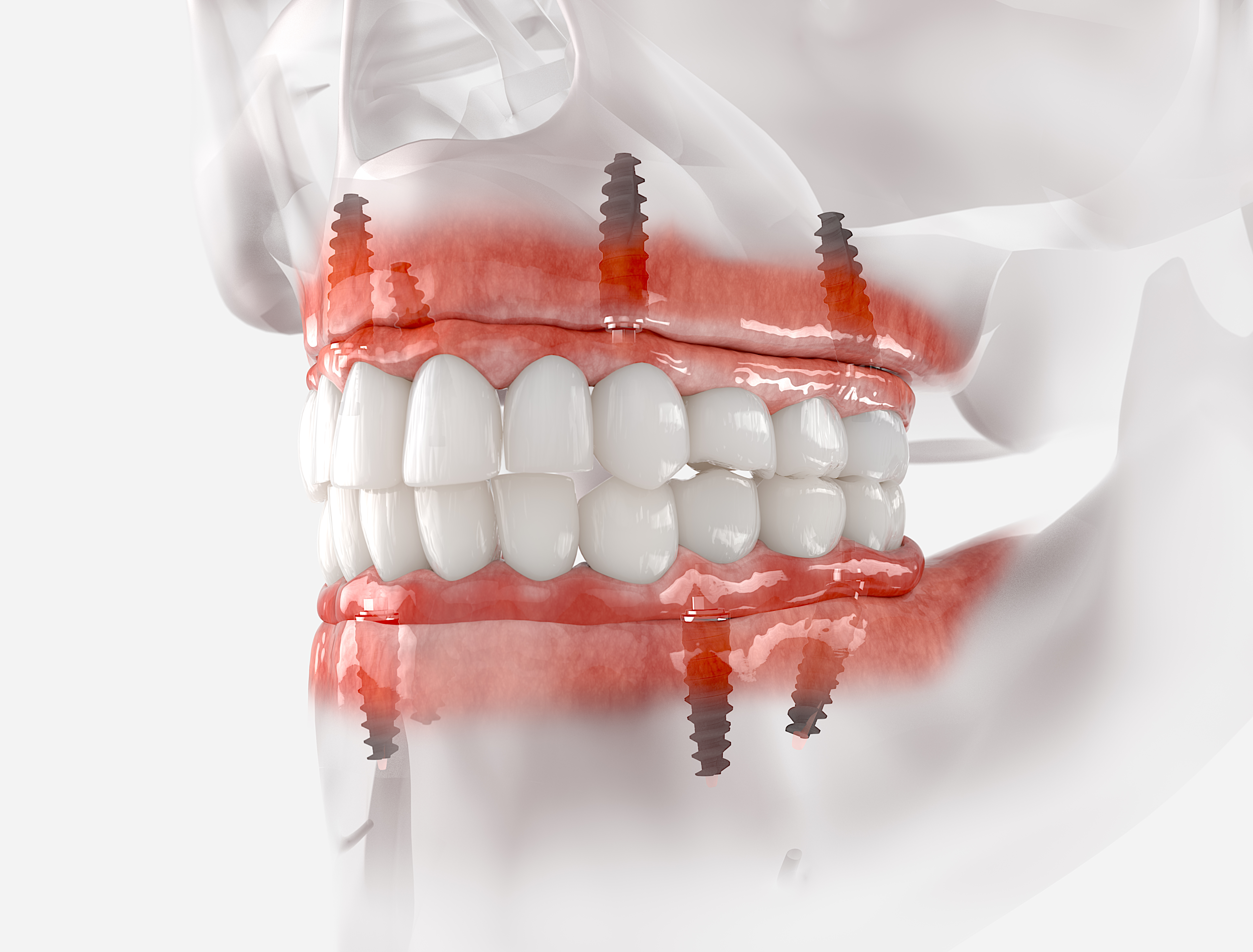 All-on-4 dental implants and denture