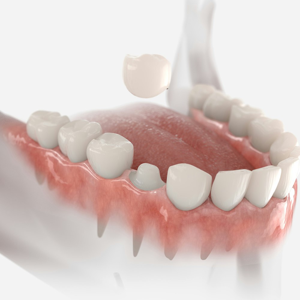 3d rendering of a dental crown
