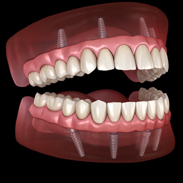 All-on-4 dental implants