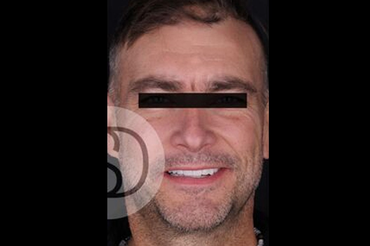 Supreme Dental Clinic patient after crowns