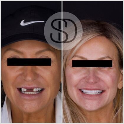 Supreme Dental Clinic patient before and after dental bridge