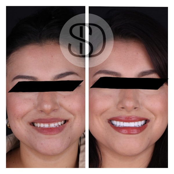 Patient before and after crowns