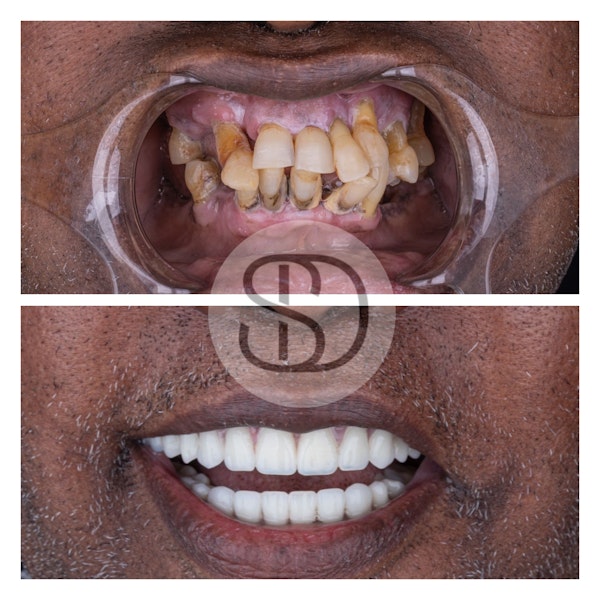 Patient before and after All-on-X