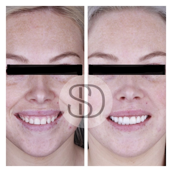 Patient before and after full mouth reconstruction in Los Algodones