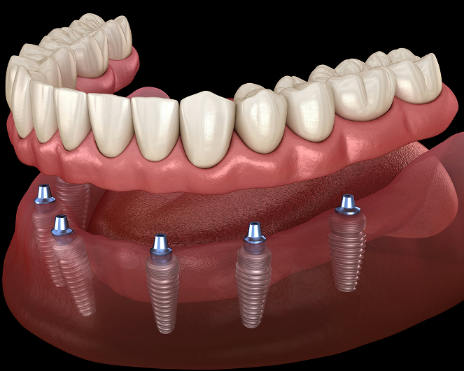 All-on-6 restoration