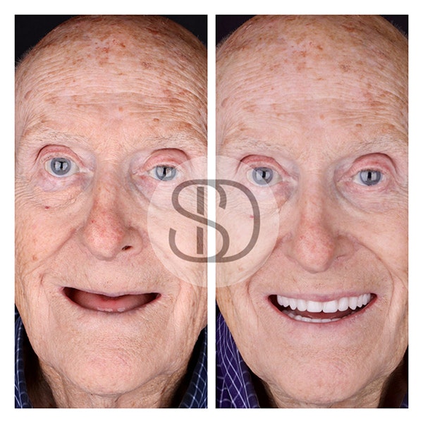 Patient before and after full mouth reconstruction in Los Algodones