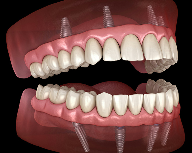 Model of All-on-4 technique