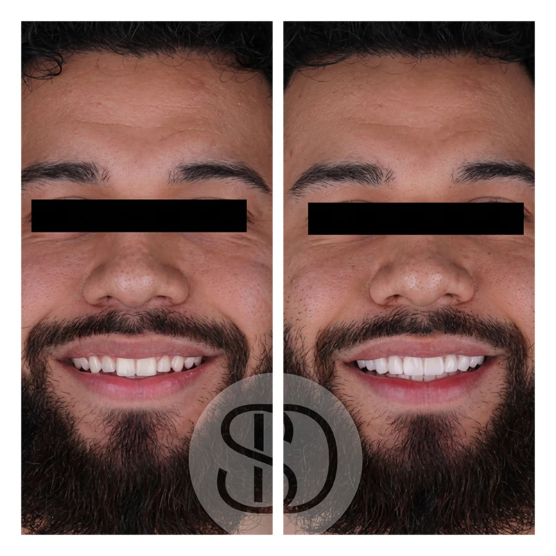 Ismael before and after veneers