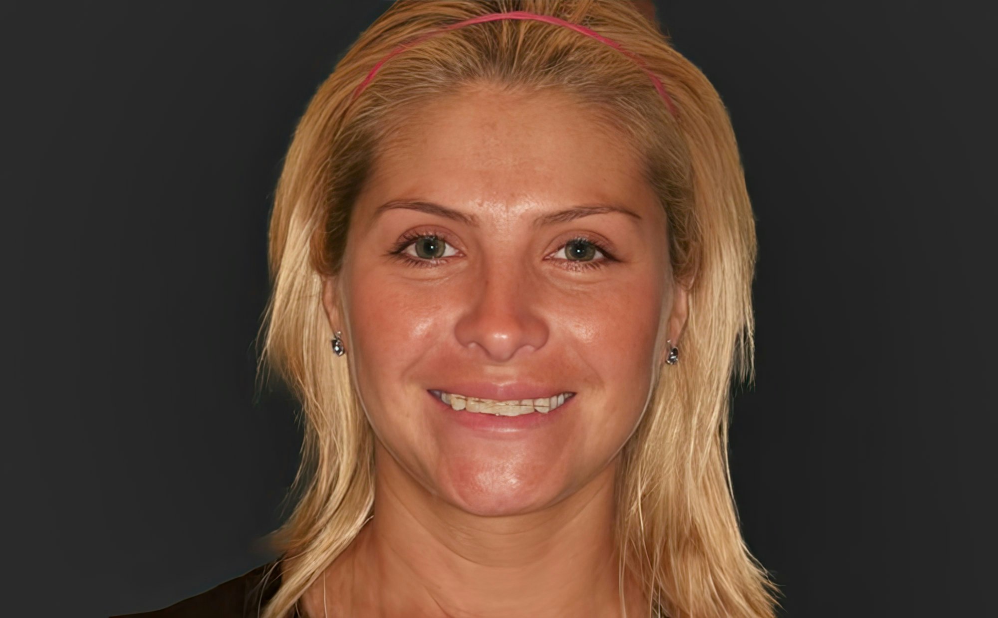 Patient with a stabilizing wire