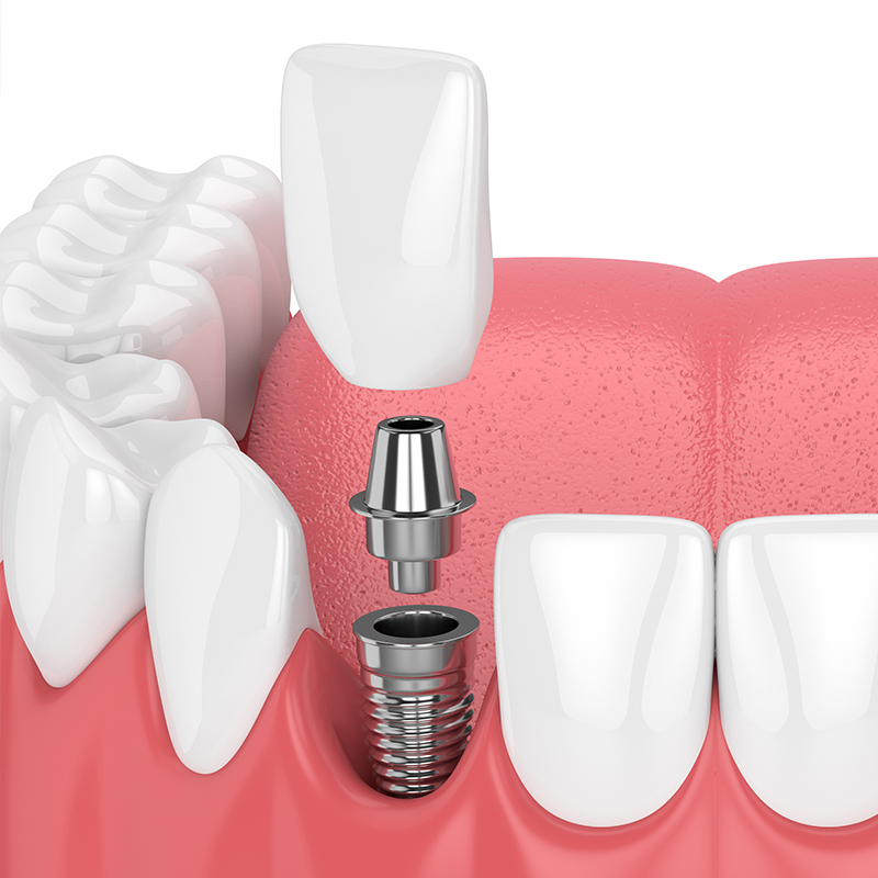 illustration of dental implants