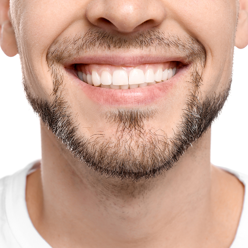 Man smiling after gummy smile treatment