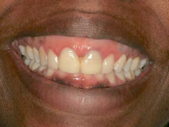 Before gum surgery with Gloria Ospina