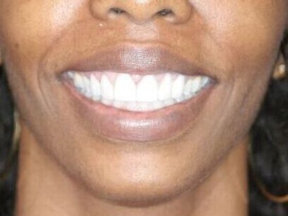 After gum surgery with Gloria Ospina