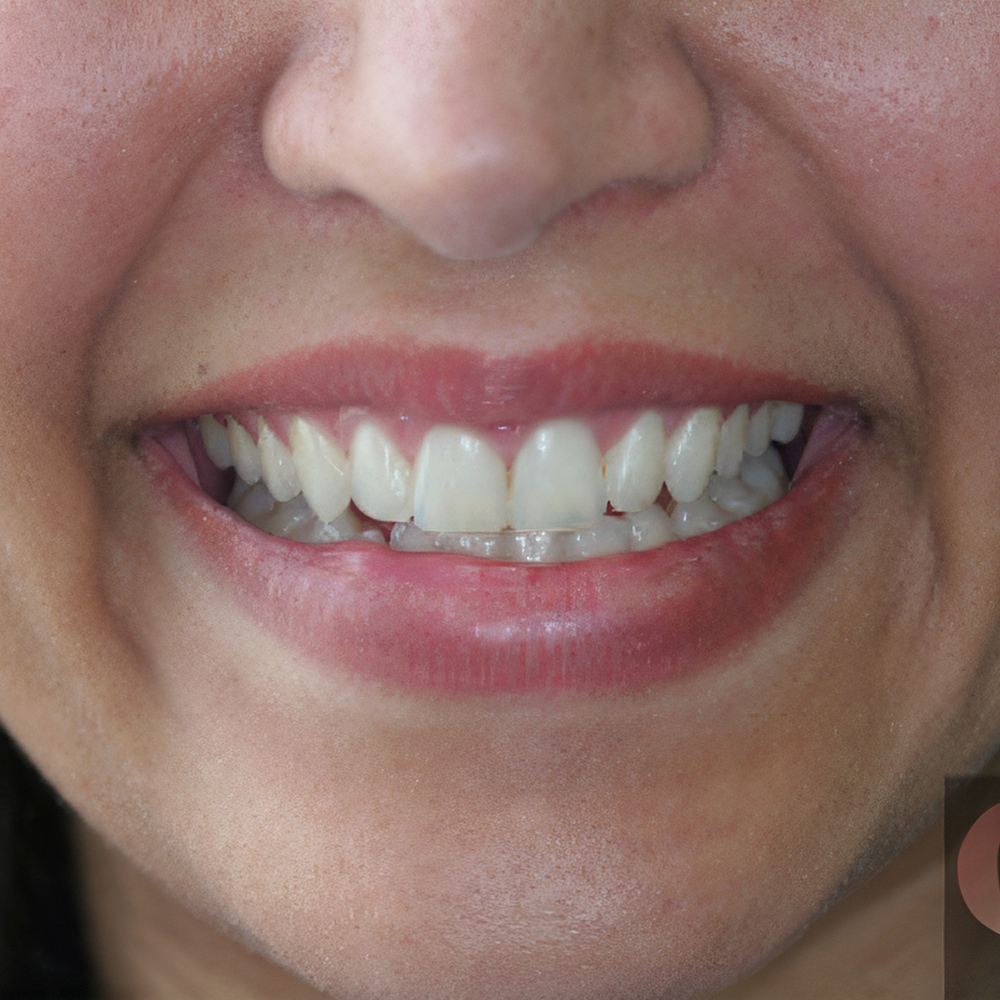 a patient's smile after treatment