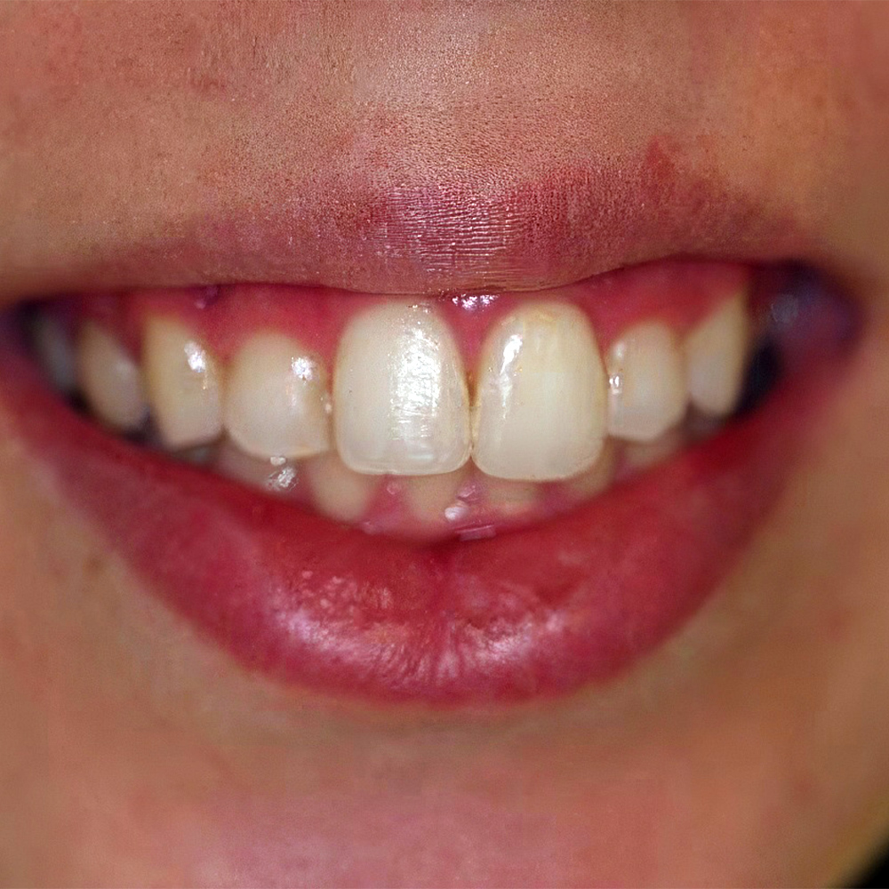 a patient's smile after treatment
