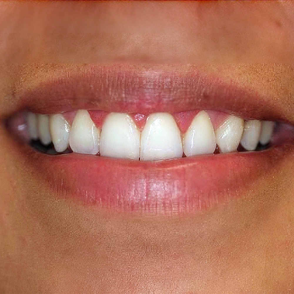 a patient's smile after treatment