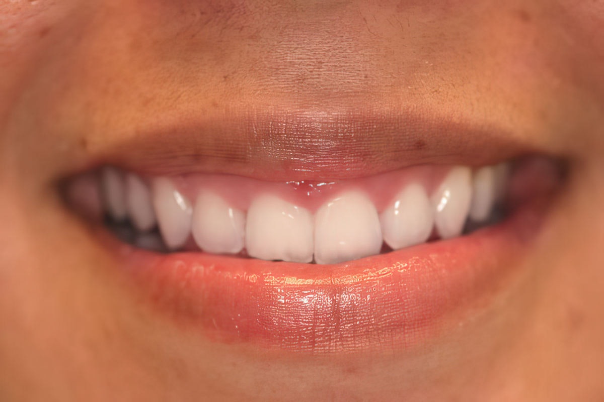 Reyna before gum contouring