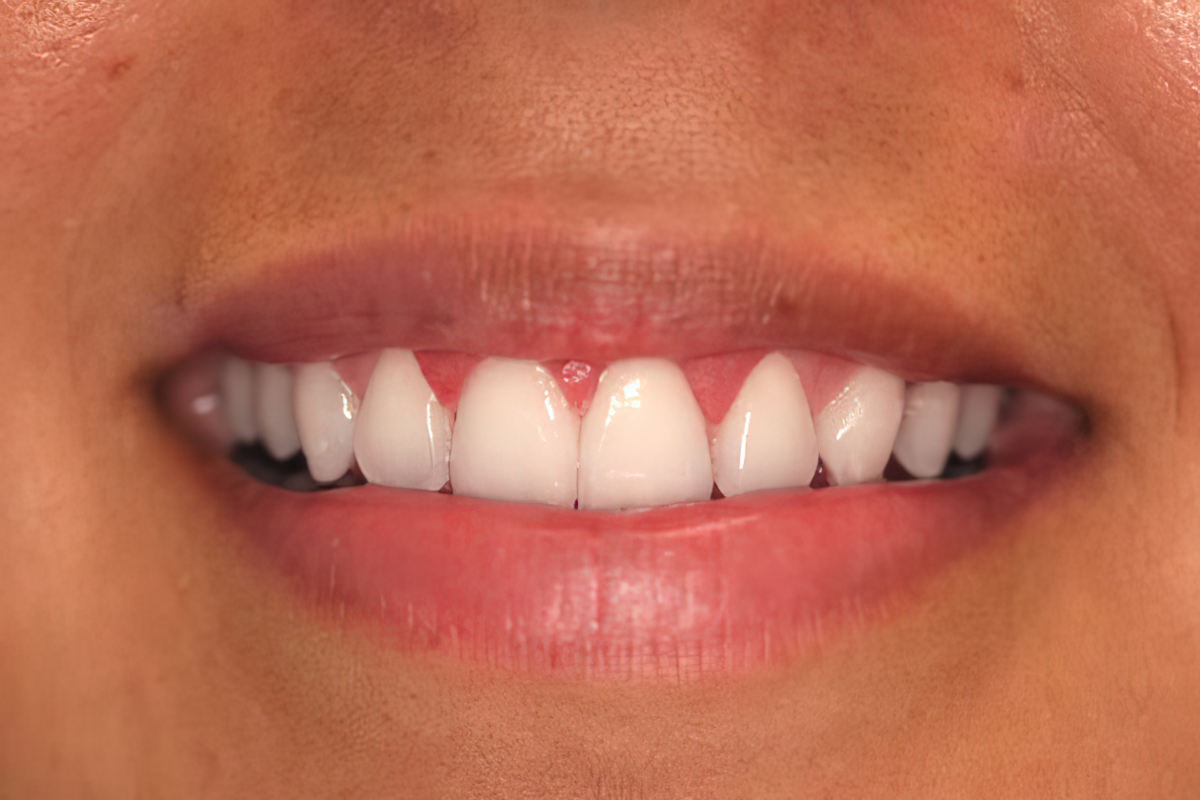 Reyna after gum contouring